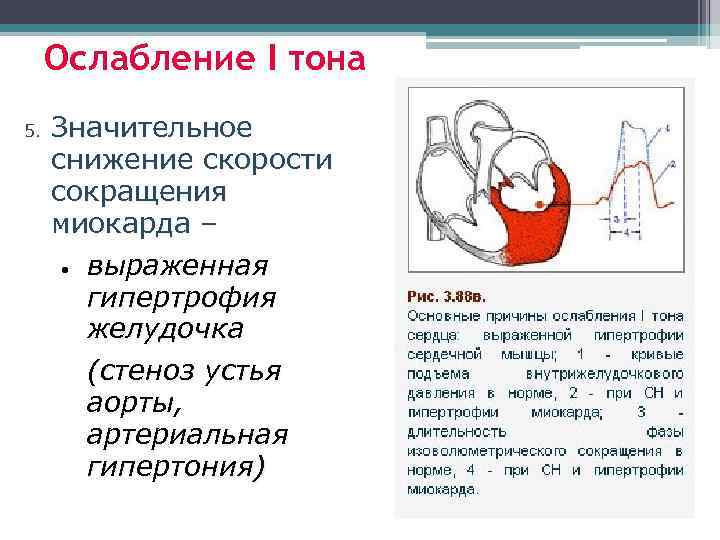 Ослабление I тона 5. Значительное снижение скорости сокращения миокарда – • выраженная гипертрофия желудочка