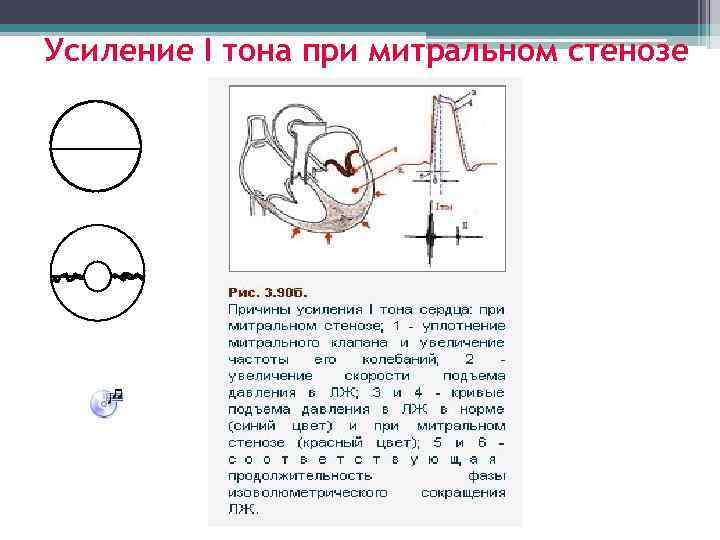 Усиление I тона при митральном стенозе 