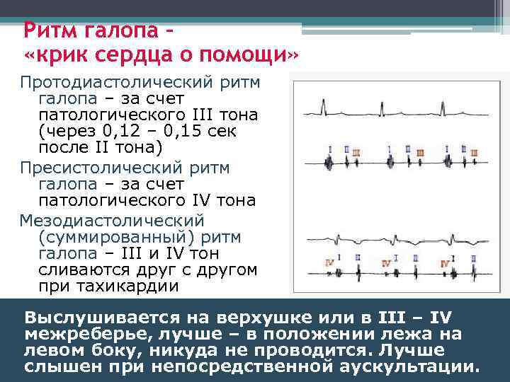 Схема ритма галопа