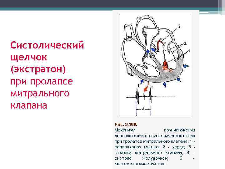 Экг при пролапсе митрального клапана фото