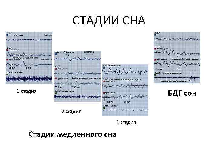 СТАДИИ СНА БДГ сон 1 стадия 2 стадия 4 стадия Стадии медленного сна 