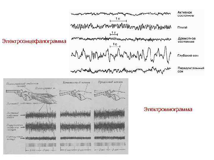 Электроэнцефалограмма Электромиограмма 