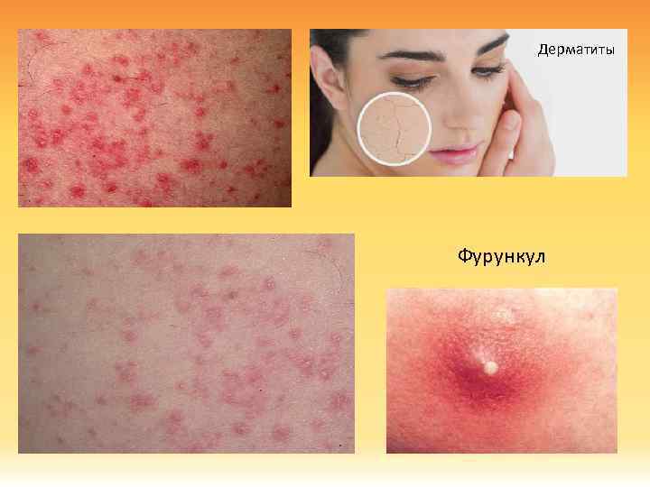 Дерматиты Фурункул 