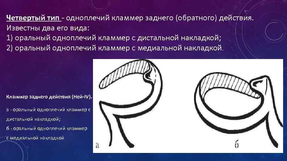 Показания к применению кламмеров