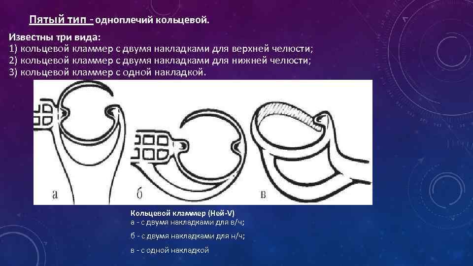 3 тип 4 тип 5. Система нея кламмеры пятого типа. Одноплечий кольцевой кламмер. Пятый кламмер одноплечий кольцевой. Моделирование 1 типа кламмера системы нея.