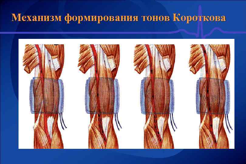 Механизм формирования тонов Короткова 