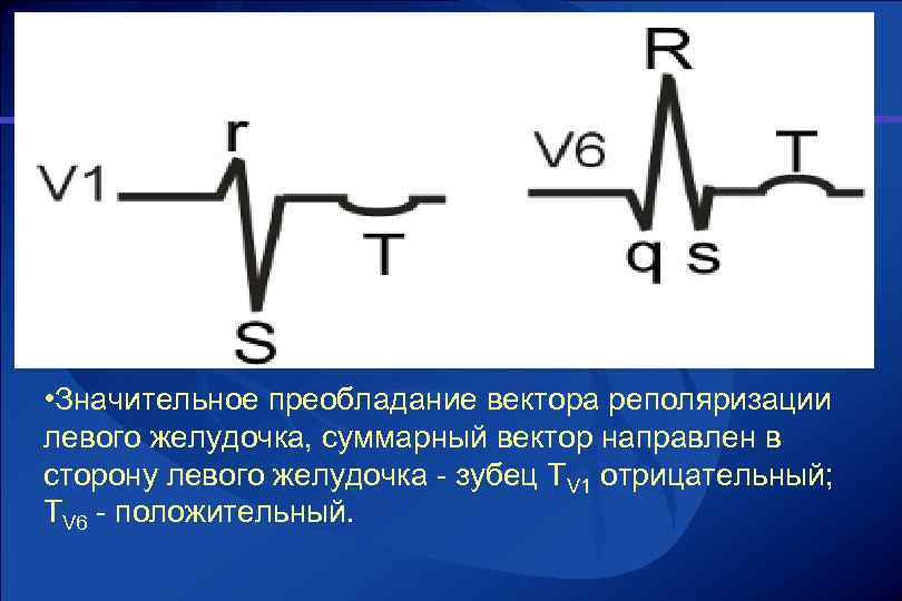  • Значительное преобладание вектора реполяризации левого желудочка, суммарный вектор направлен в сторону левого