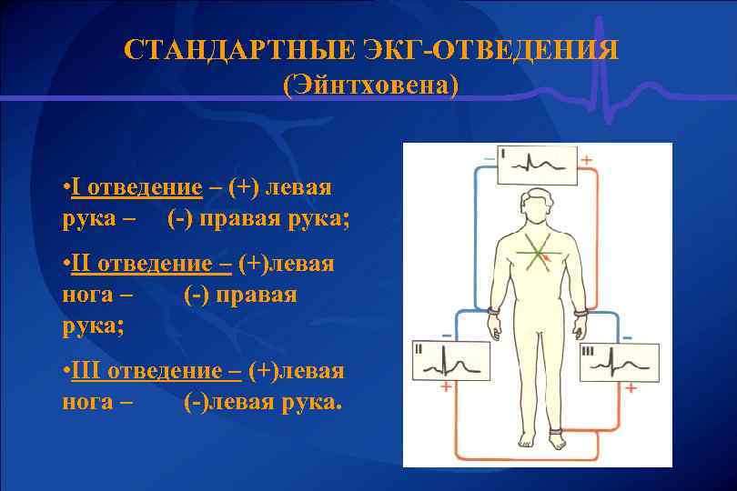 СТАНДАРТНЫЕ ЭКГ-ОТВЕДЕНИЯ (Эйнтховена) • I отведение – (+) левая рука – (-) правая рука;