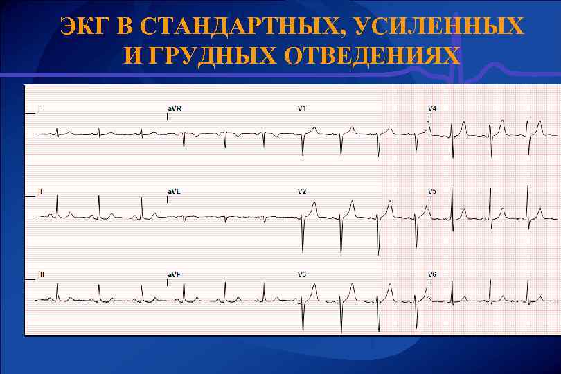 ЭКГ В СТАНДАРТНЫХ, УСИЛЕННЫХ И ГРУДНЫХ ОТВЕДЕНИЯХ 