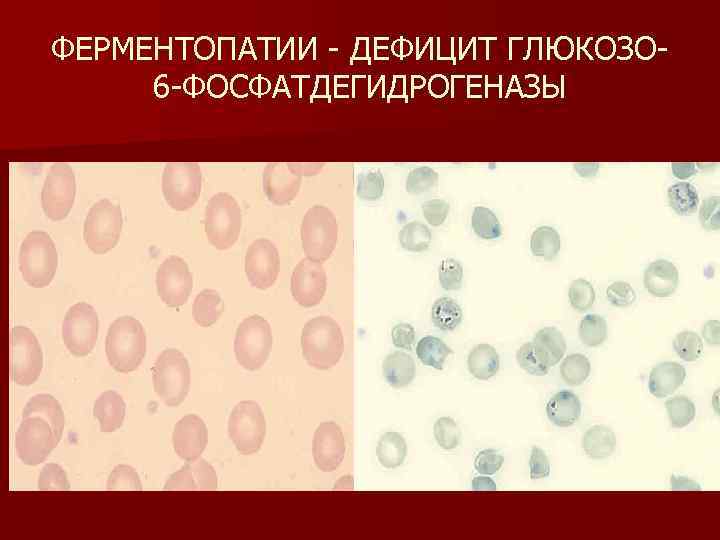 ФЕРМЕНТОПАТИИ ДЕФИЦИТ ГЛЮКОЗО 6 ФОСФАТДЕГИДРОГЕНАЗЫ 