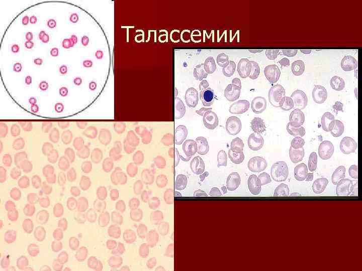 Талассемии 