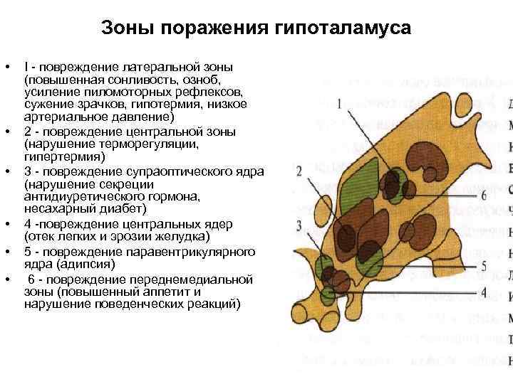 Зоны поражения гипоталамуса • • • I - повреждение латеральной зоны (повышенная сонливость, озноб,