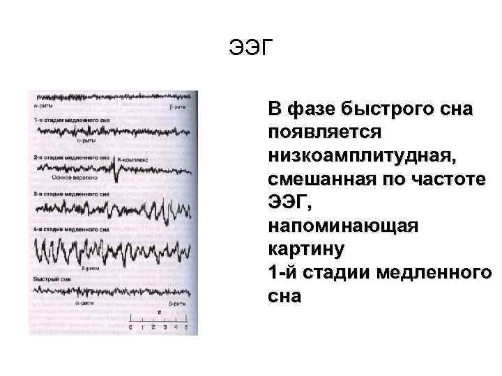 ЭЭГ В фазе быстрого сна появляется низкоамплитудная, смешанная по частоте ЭЭГ, напоминающая картину 1