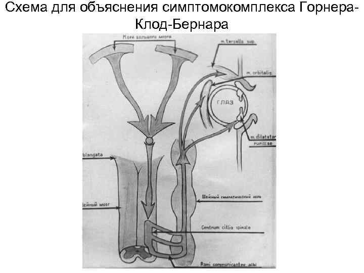 Схема для объяснения симптомокомплекса Горнера. Клод-Бернара 