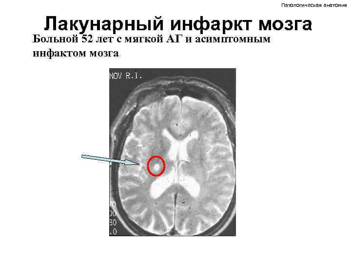Патологическая анатомия Лакунарный инфаркт мозга Больной 52 лет с мягкой АГ и асимптомным инфактом
