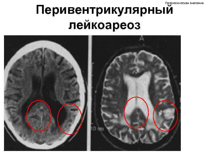 Патологическая анатомия Перивентрикулярный лейкоареоз 