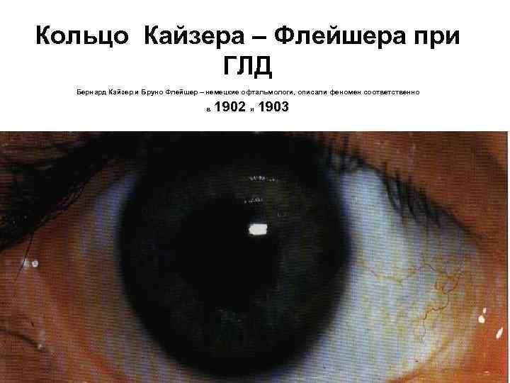 Кольцо Кайзера – Флейшера при ГЛД Бернард Кайзер и Бруно Флейшер – немецкие офтальмологи,