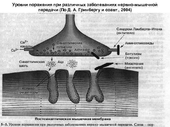 Нарушение мышечного передачи. Нервно мышечная передача. Заболевания нервно мышечной передачи. Классификация нервно-мышечных заболеваний. Заболевания нарушение нервно мышечной передачи.