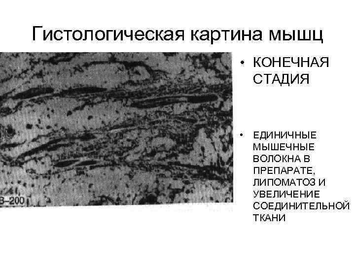 Гистологическая картина мышц • КОНЕЧНАЯ СТАДИЯ • ЕДИНИЧНЫЕ МЫШЕЧНЫЕ ВОЛОКНА В ПРЕПАРАТЕ, ЛИПОМАТОЗ И