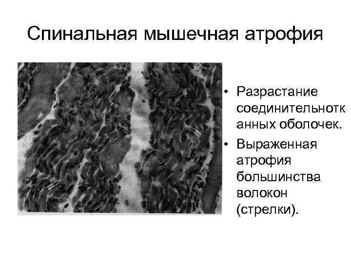 Спинальная мышечная атрофия • Разрастание соединительнотк анных оболочек. • Выраженная атрофия большинства волокон (стрелки).