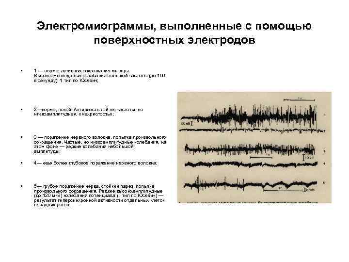 Электромиограммы, выполненные с помощью поверхностных электродов • 1 — норма, активное сокращение мышцы. Высокоамплитудные