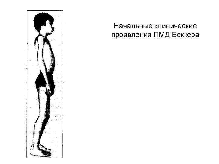 Начальные клинические проявления ПМД Беккера 