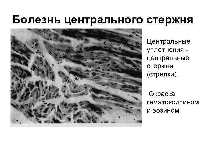 Болезнь центрального стержня • Центральные уплотнения центральные стержни (стрелки). • Окраска гематоксилином и эозином.