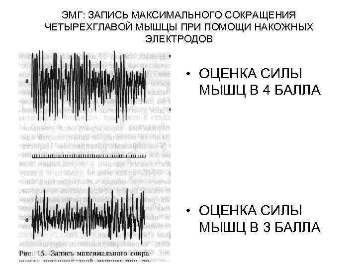 ЭМГ: ЗАПИСЬ МАКСИМАЛЬНОГО СОКРАЩЕНИЯ ЧЕТЫРЕХГЛАВОЙ МЫШЦЫ ПРИ ПОМОЩИ НАКОЖНЫХ ЭЛЕКТРОДОВ • ОЦЕНКА СИЛЫ МЫШЦ