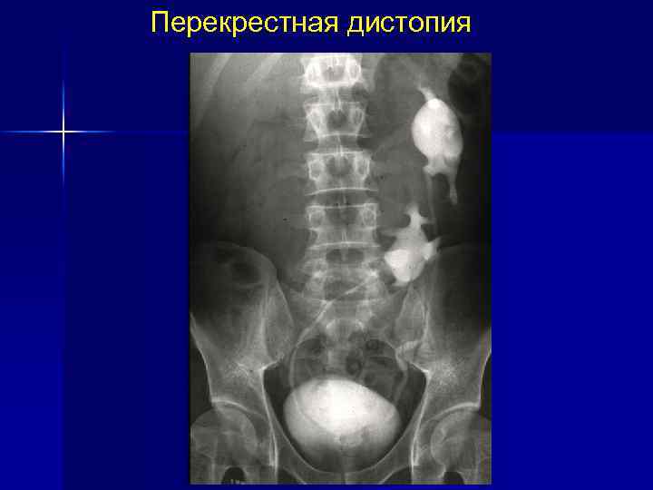 Нефроптоз дистопия. Подвздошная дистопия почки рентген. Гетеролатеральная перекрестная дистопия почки. Экскреторная урография дистопия.