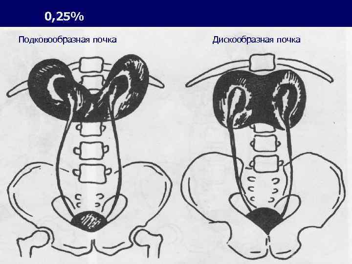 0, 25% Подковообразная почка Дискообразная почка 