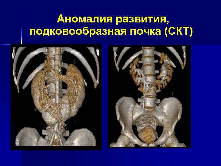 Аномалия развития, подковообразная почка (СКТ) 