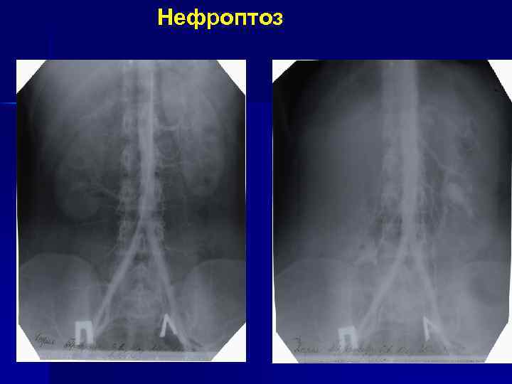 Нефроптоз это