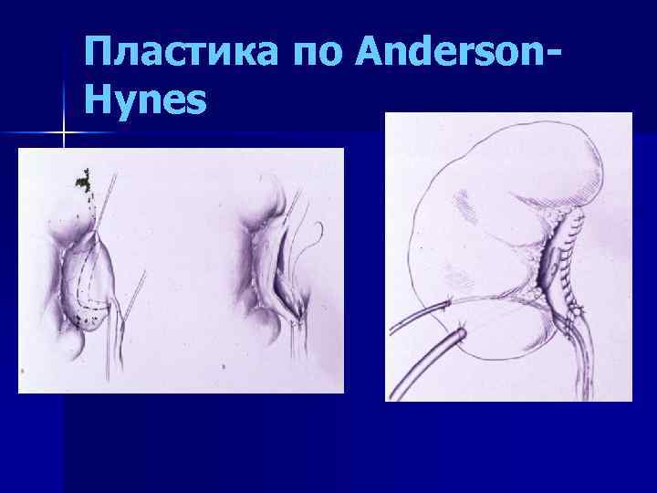 Пластика по Anderson. Hynes 