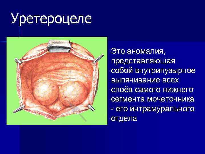 Уретероцеле Это аномалия, представляющая собой внутрипузырное выпячивание всех слоёв самого нижнего сегмента мочеточника -