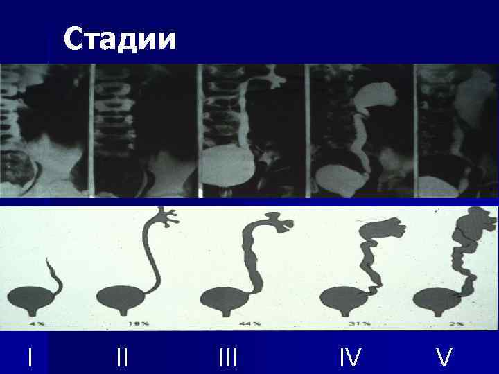 Стадии I II IV V 