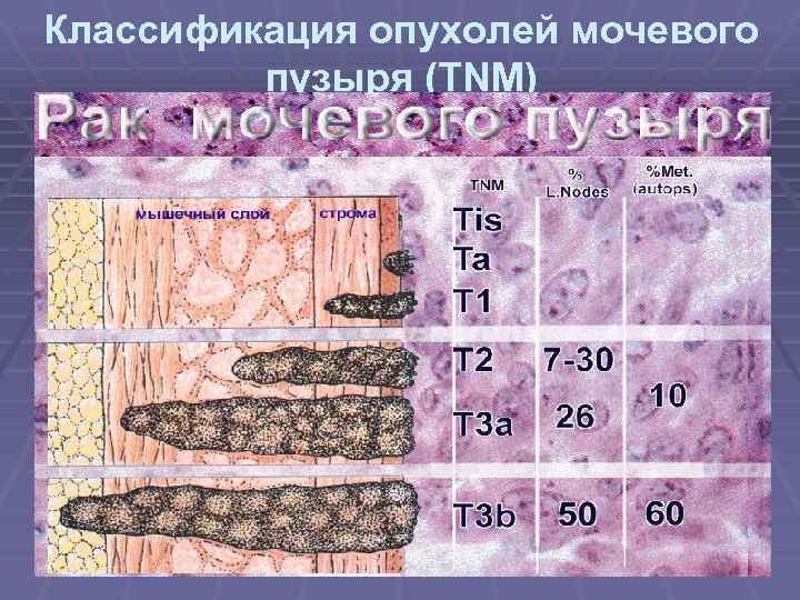 Классификация опухолей мочевого пузыря (ТNM) 