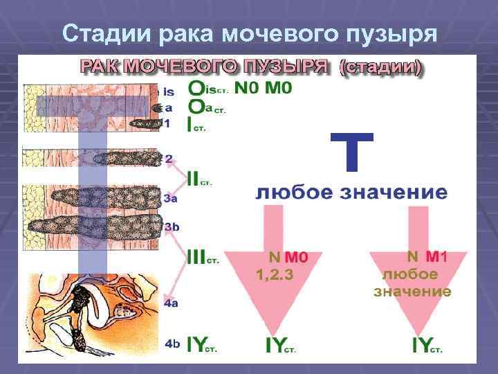 Стадии рака мочевого пузыря 