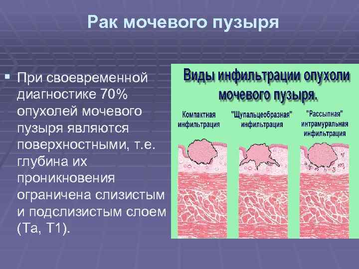 Рак мочевого пузыря § При своевременной диагностике 70% опухолей мочевого пузыря являются поверхностными, т.