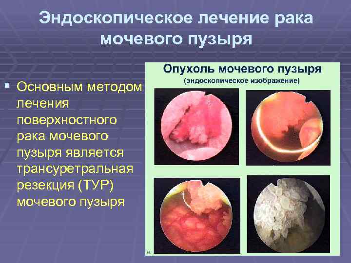 Эндоскопическое лечение рака мочевого пузыря § Основным методом лечения поверхностного рака мочевого пузыря является