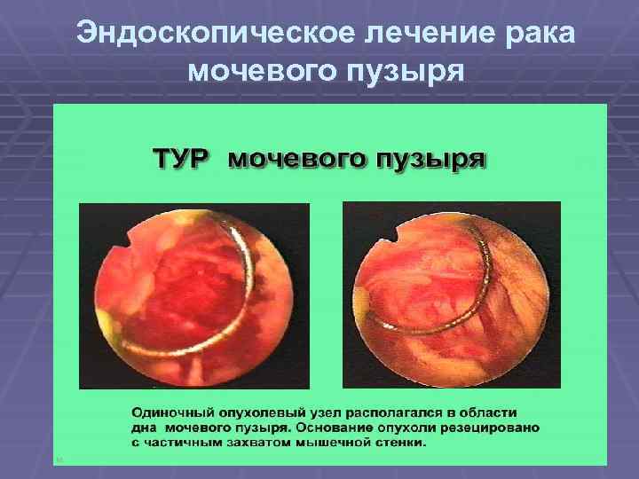 Эндоскопическое лечение рака мочевого пузыря 