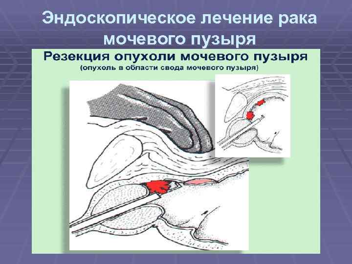 Эндоскопическое лечение рака мочевого пузыря 