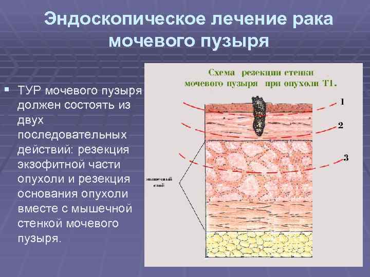 Эндоскопическое лечение рака мочевого пузыря § ТУР мочевого пузыря должен состоять из двух последовательных