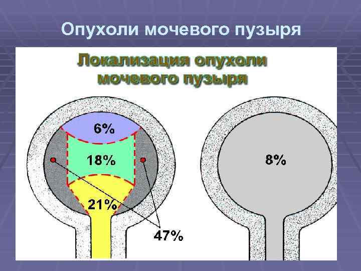 Опухоли мочевого пузыря 