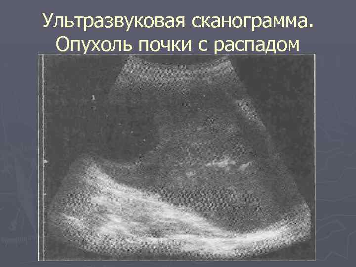 Ультразвуковая сканограмма. Опухоль почки с распадом 