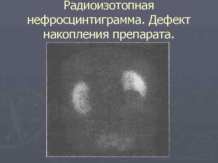 Радиоизотопная нефросцинтиграмма. Дефект накопления препарата. 