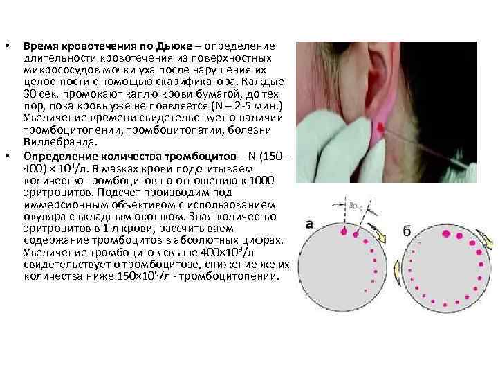 Кровотечение по форестеру