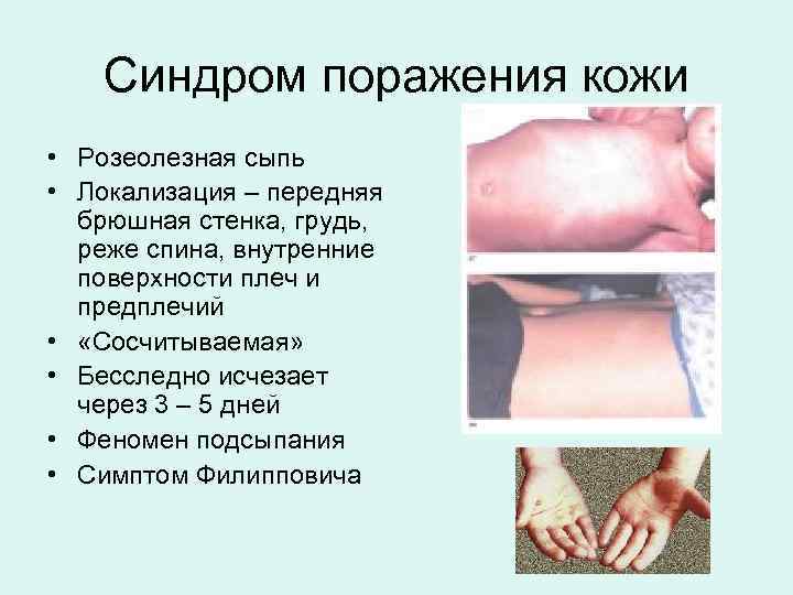 Язык при брюшном тифе фото