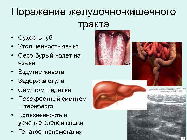 Поражение желудочно-кишечного тракта • Сухость губ • Утолщенность языка • Серо-бурый налет на языке