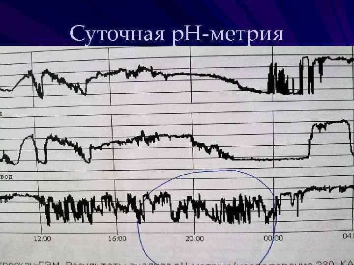 Суточная р. Н-метрия 