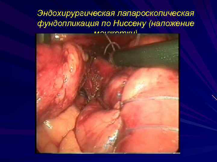 Эндохирургическая лапароскопическая фундопликация по Ниссену (наложение манжетки) 